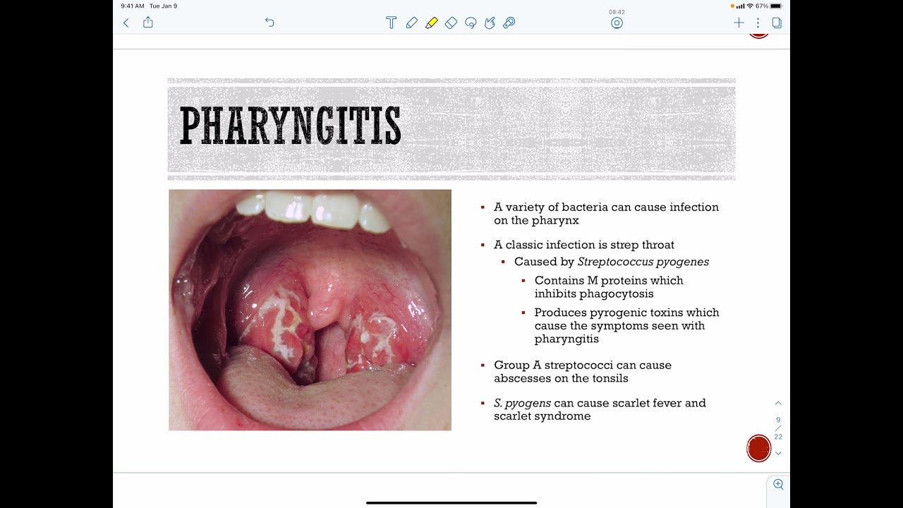 Upper Respiratory Tract Infections