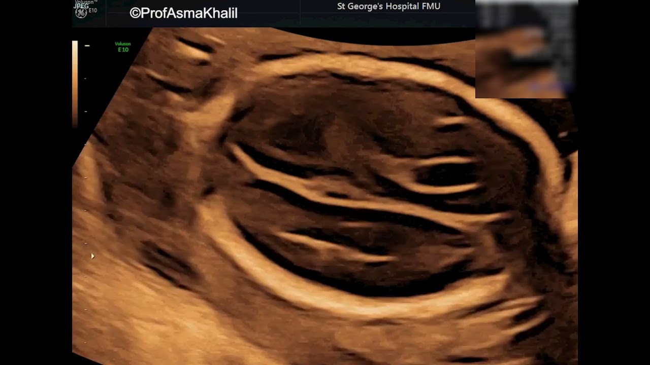 Fetus with congenital CMV infection and multiple brain abnormalities #ISUOGEducation