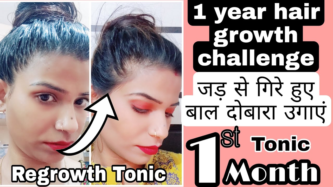 1 Year Hair Growth 💹 Challenge 8No  खोए हुए बालों को वापस पाएं। 1st Month Hair Regrowth Tonic