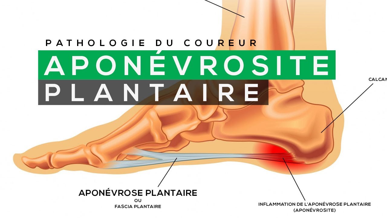 COMMENT TRAITER L'APONÉVROSITE PLANTAIRE ?
