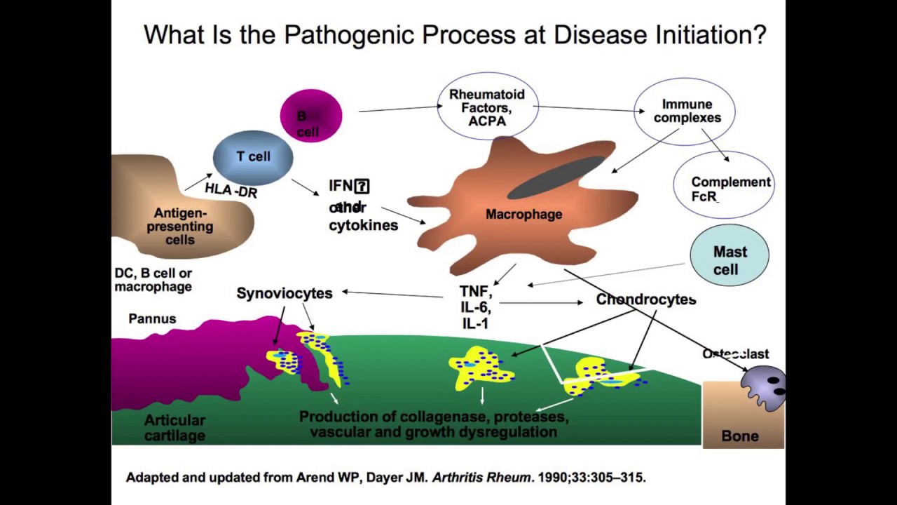 Pre-Rheumatoid Arthritis: Can We Define It and Prevent Its Progression?