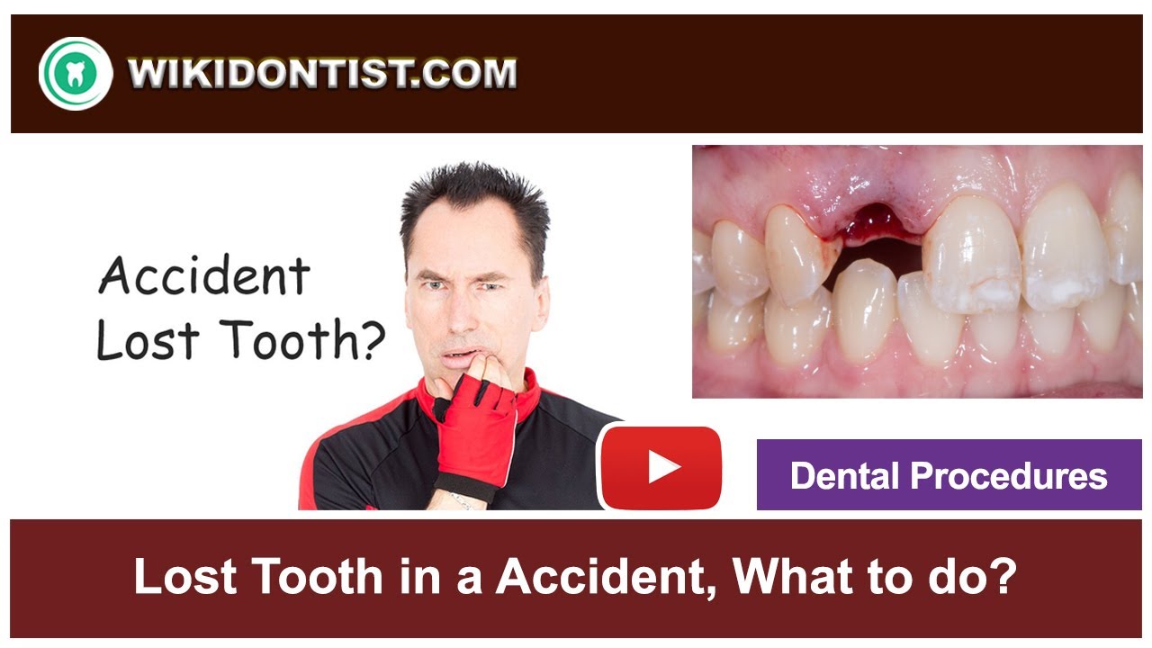 Lost Tooth in a Accident, What to do ?