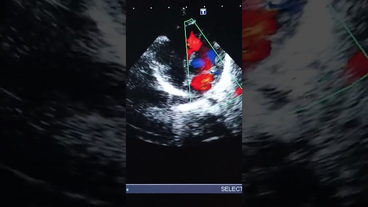 Muscular Ventricular Septal Defect On  Echocardiogram #shorts