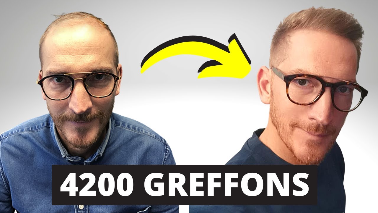 Résultat Greffe de Cheveux 🏆 - Guillaume est transformé par sa greffe de cheveux