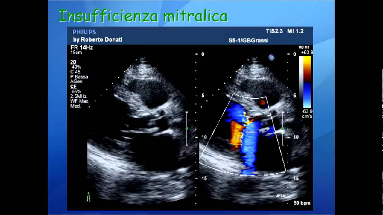 Elementi di ecocardiografia: VIII video, valvulopatia mitralica.