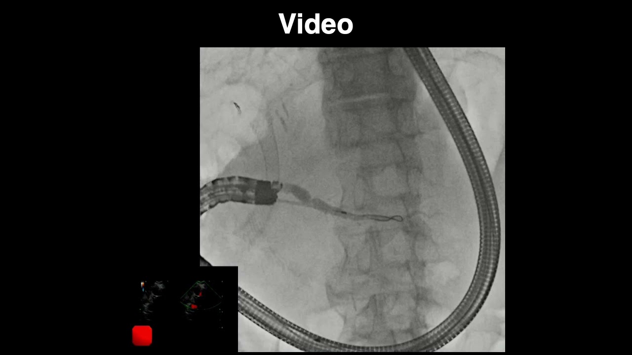 Endoscopic ultrasound-guided pancreaticoduodenostomy with a forward-viewing echoendoscope