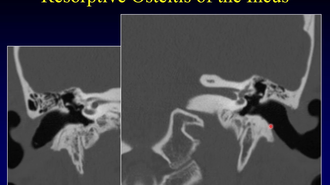 Temporal Bone Pathology 7: Hearing Loss Part 2