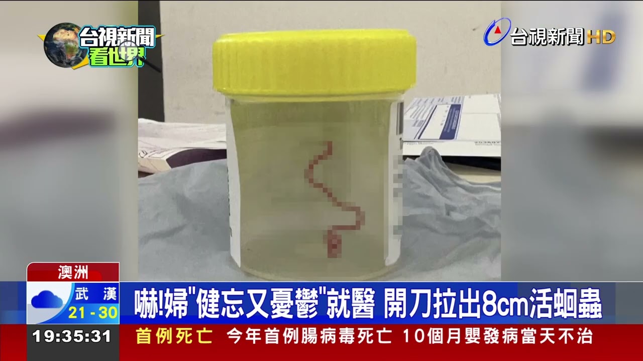 嚇！婦「健忘又憂鬱」就醫 開刀拉出8cm活蛔蟲