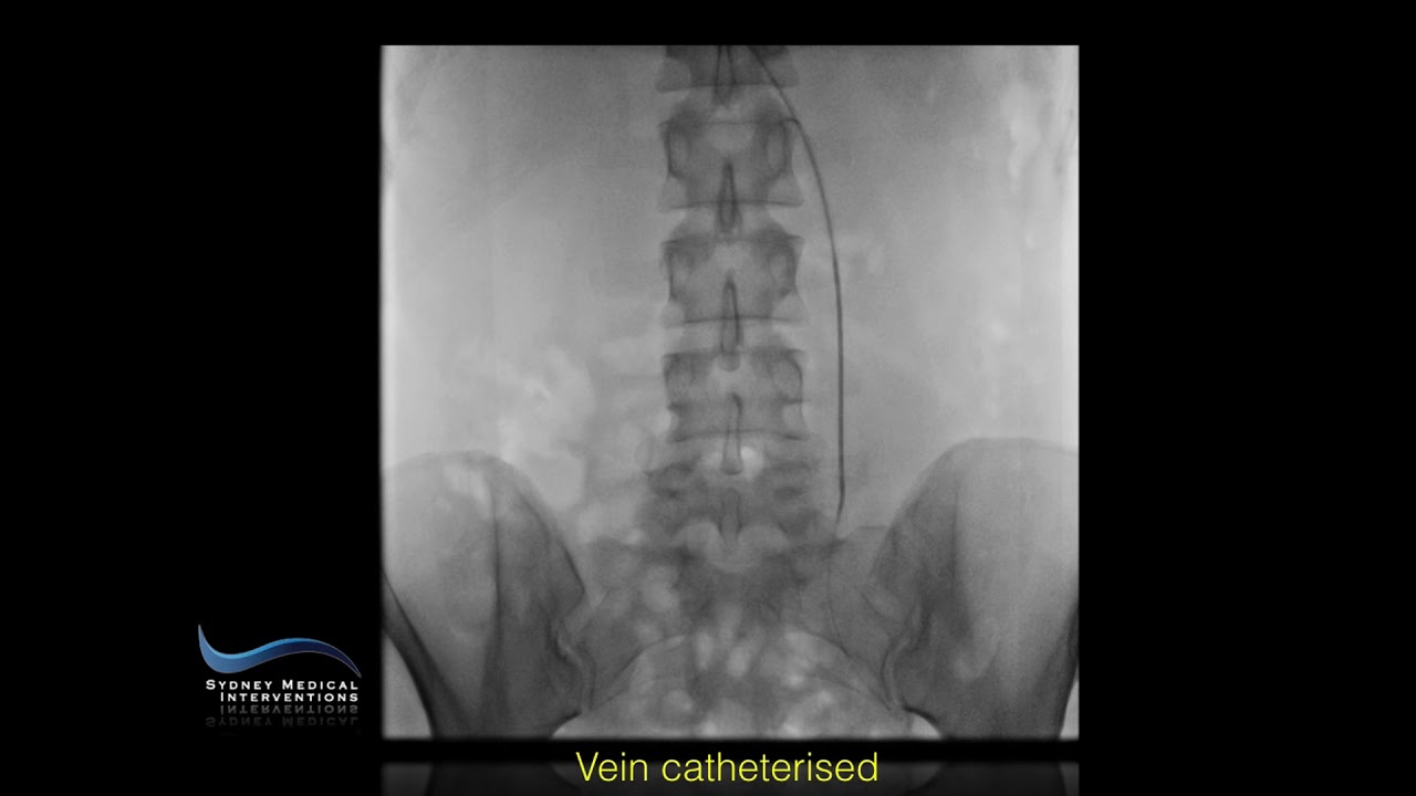 VARICOCOELE EMBOLISATION
