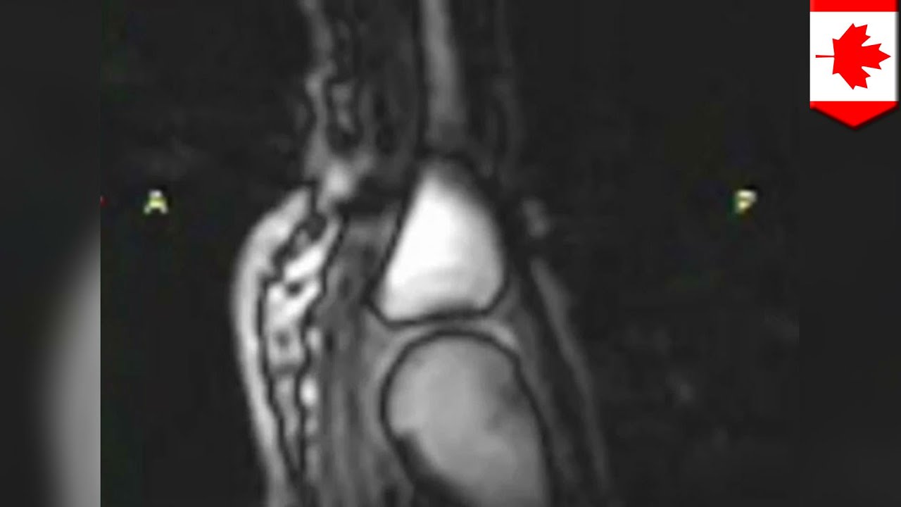 Knuckle cracking: What happens when you crack your knuckles revealed by MRI video
