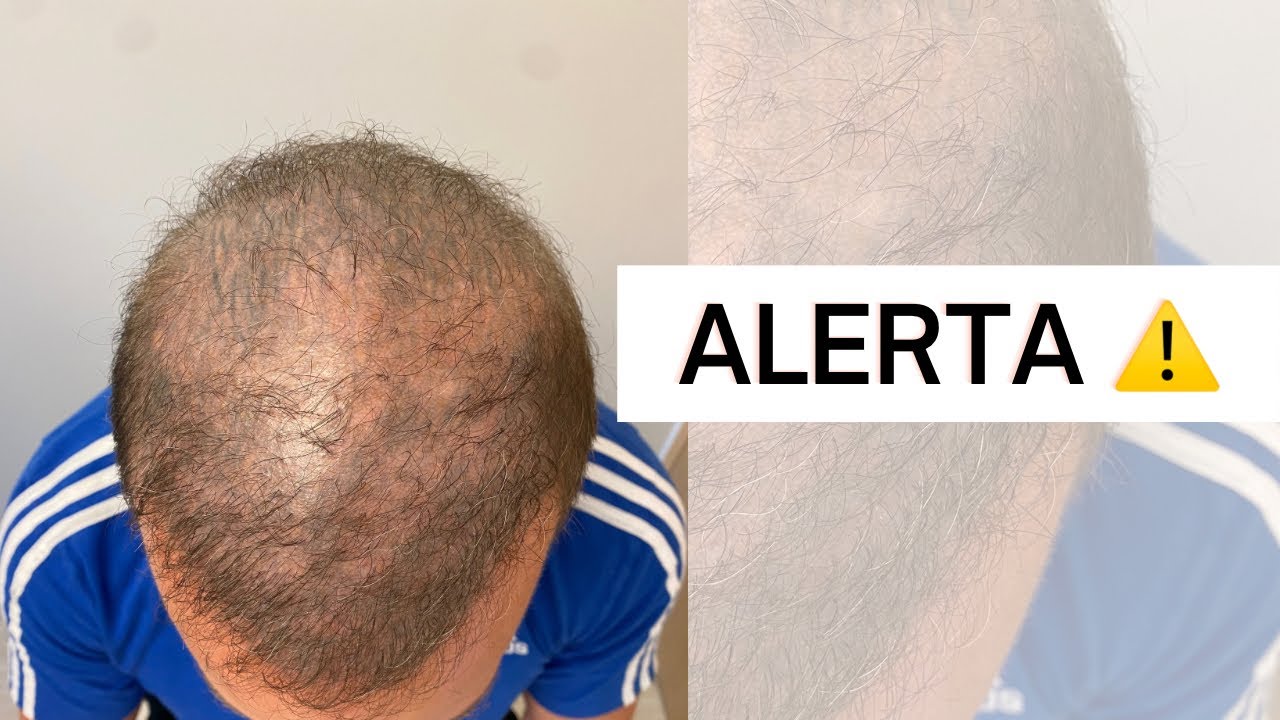 TRANSPLANTE CAPILAR QUE DEU ERRADO! ALERTA!