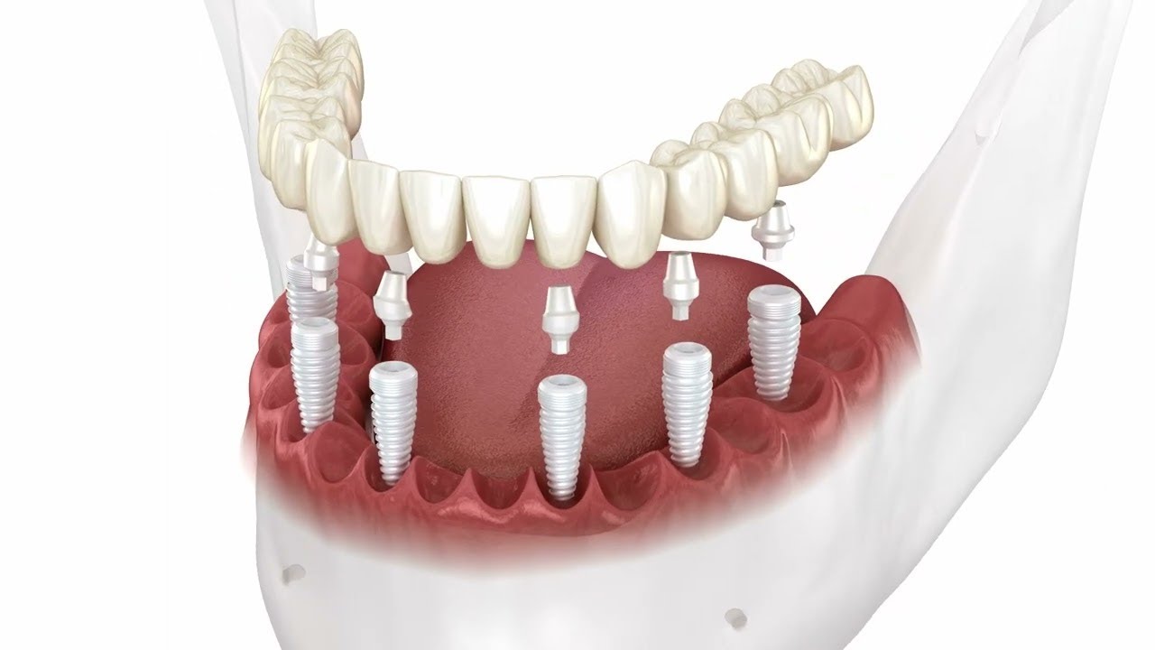T&Eacute;CNICAS EN IMPLANTES DENTALES: ALL ON 4 - 6 - 8 - EL DOCTOR EN CASA TV
