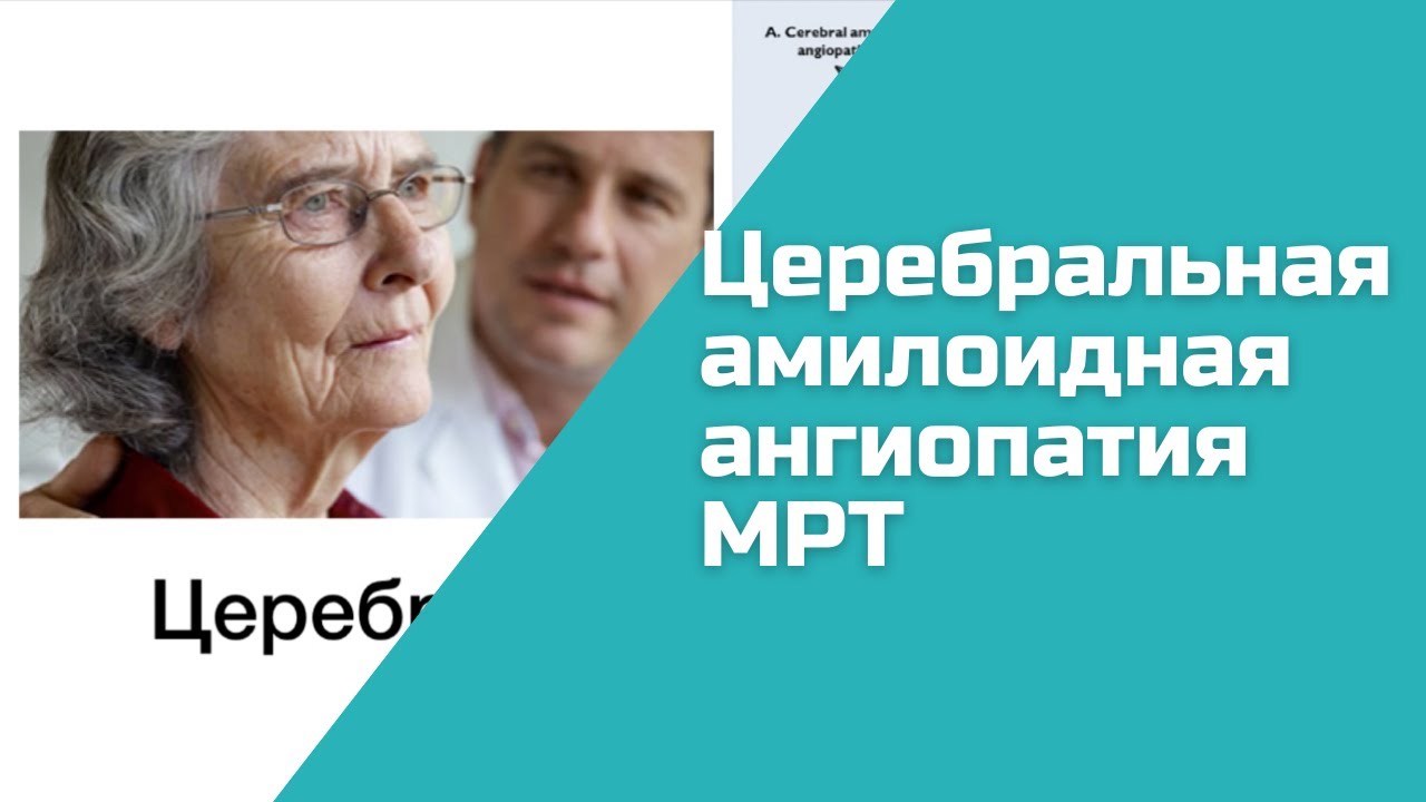 Церебральная амилоидная ангиопатия, МРТ признаки