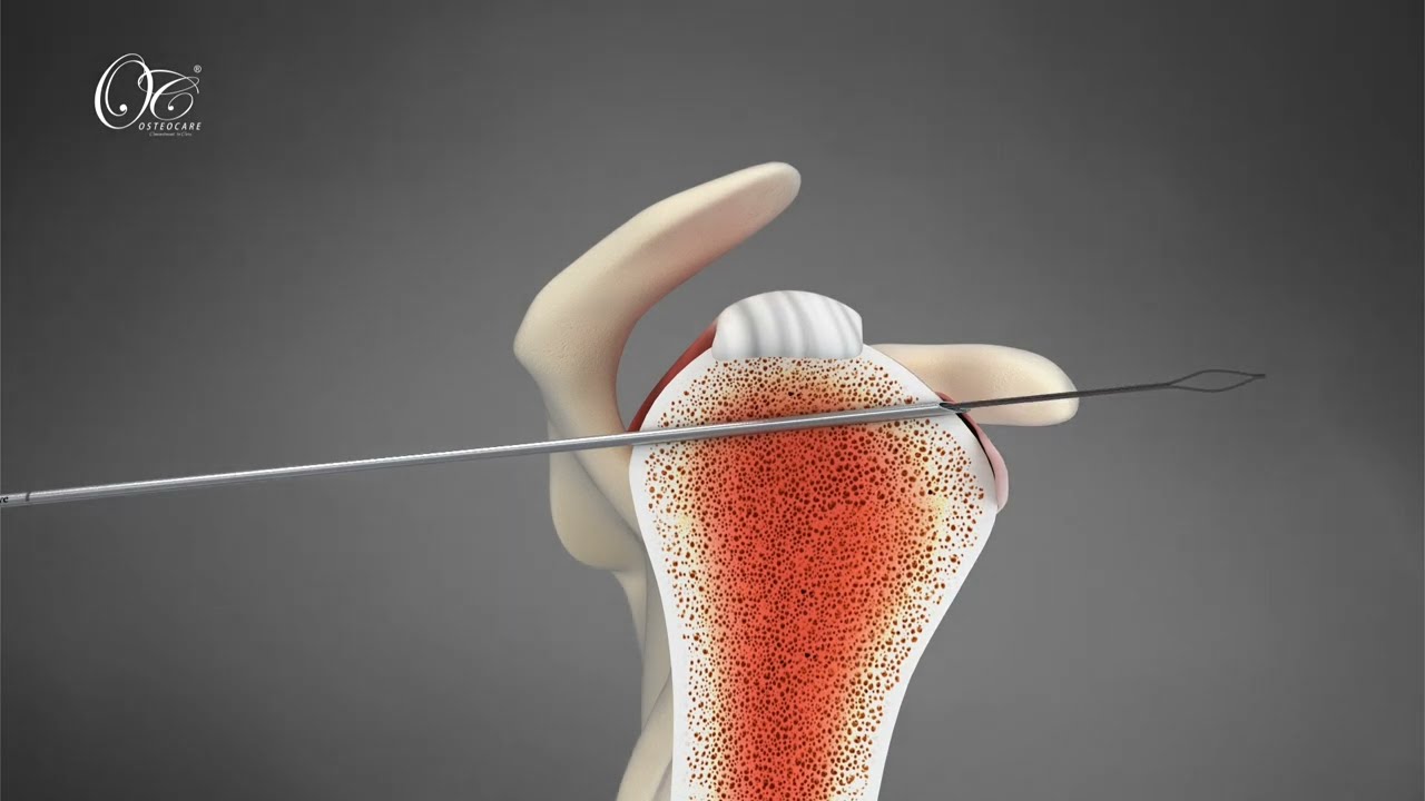 Subscapularis repair with retro anchor . New technique 