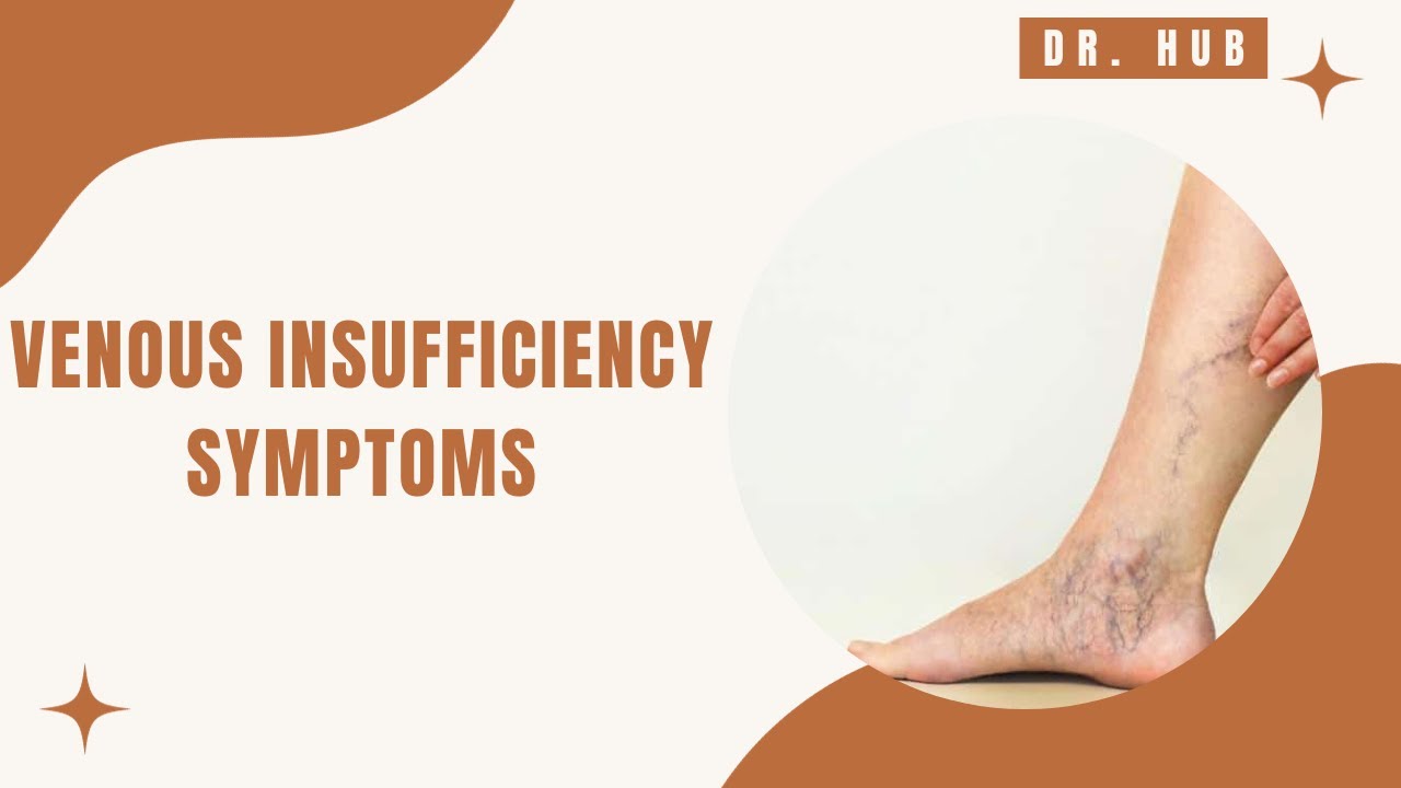 VENOUS INSUFFICIENCY SYMPTOMS #dailydosemedico