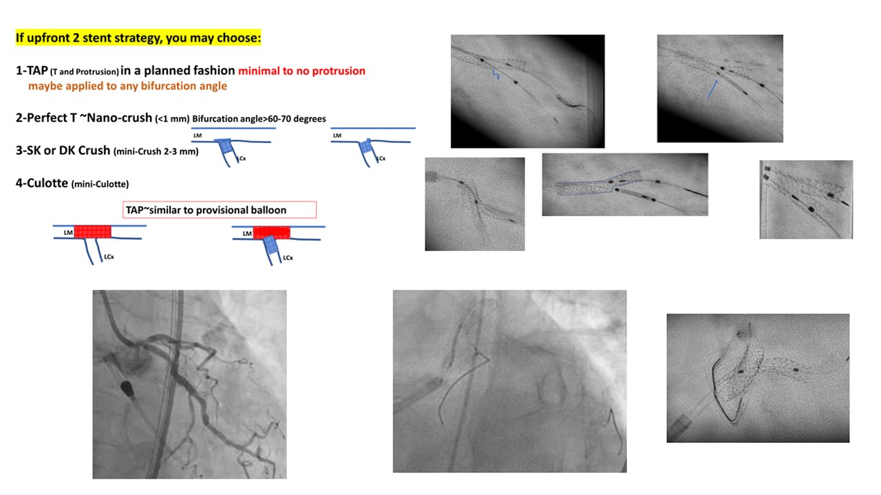 Bifurcation Left main part 2: case studies (2-stent techniques)