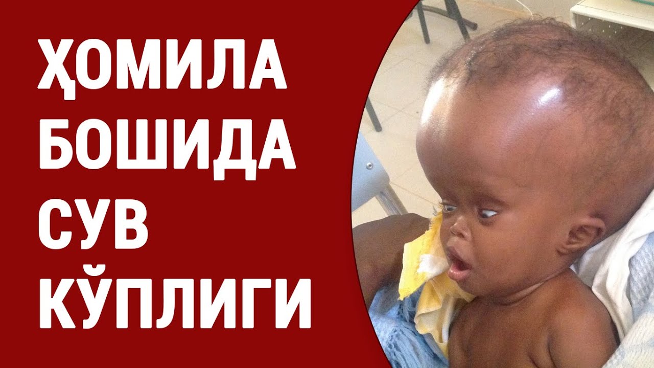 Ҳомила бошида сув кўплиги