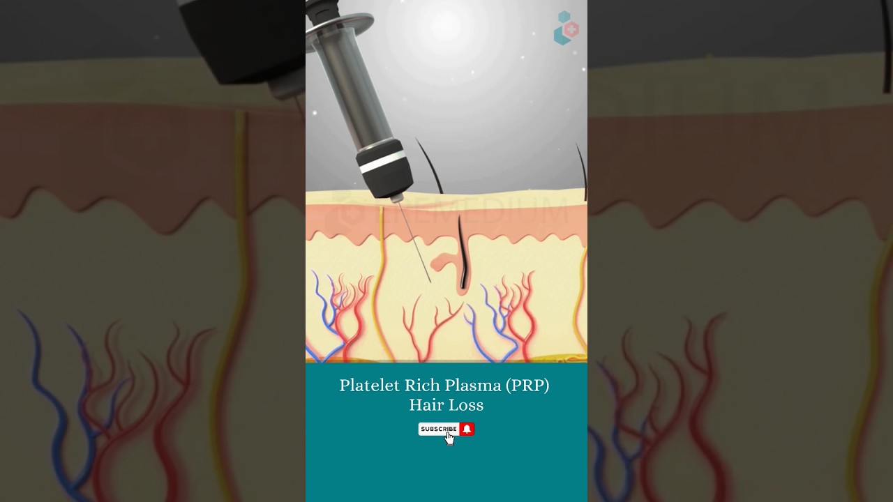 Platelet Rich Plasma and Its Use in Hair Regrowth ↪ 3D Medical Animation #Shorts #PRP #Hair #Health