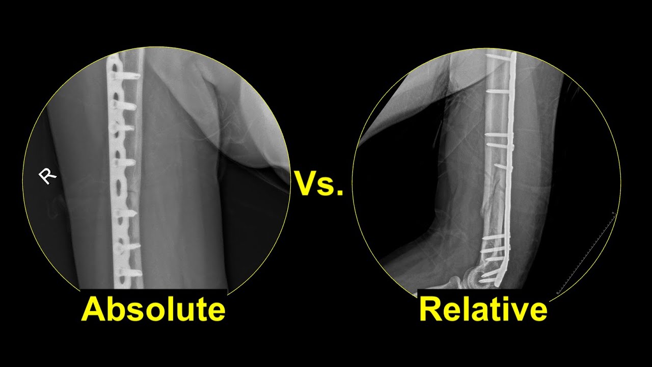 Absolute Stability Relative Stability Strain Theory: Fracture Healing