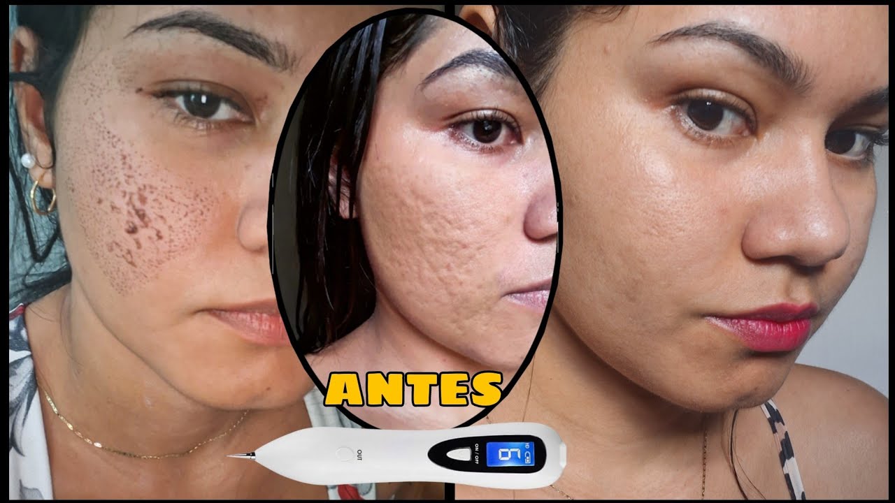 ANTES E DEPOIS CICATRIZES DE ACNE -Dermaroller e jato de plasma, caseiro. respostas