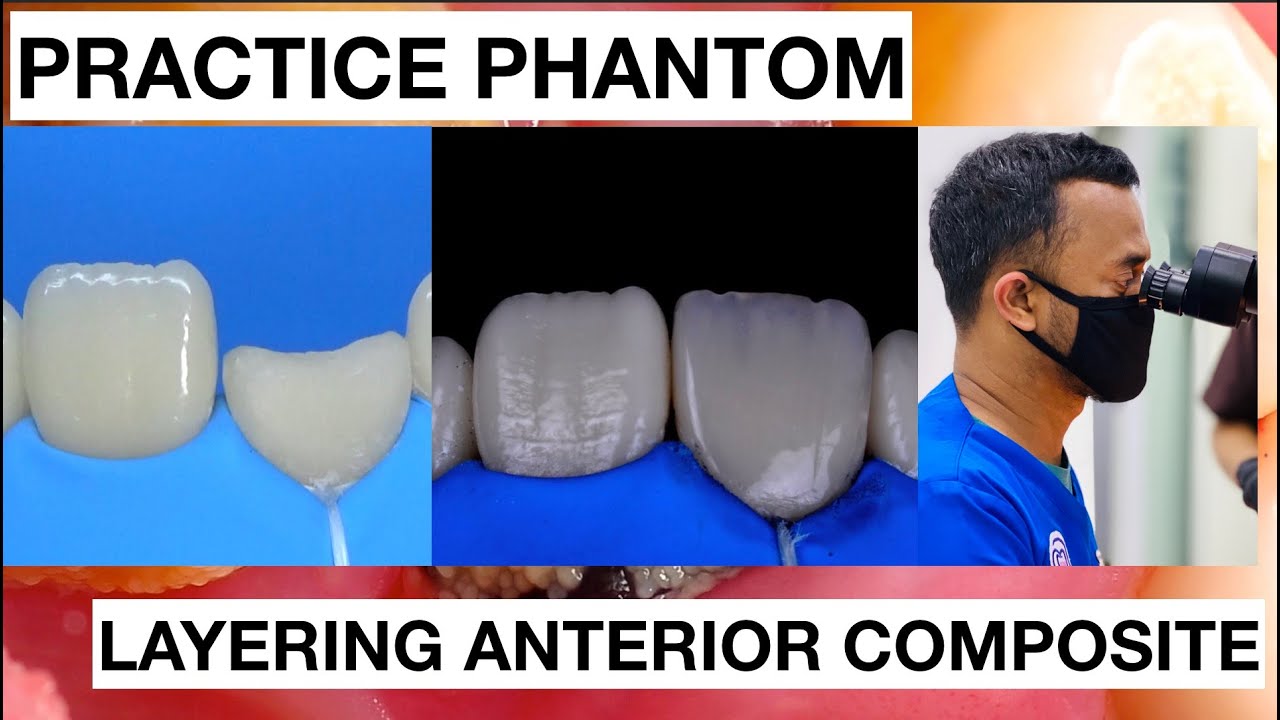 Step by Step Layering Anterior Composite | Finishing Polishing Composite | General Dentist Griya RR