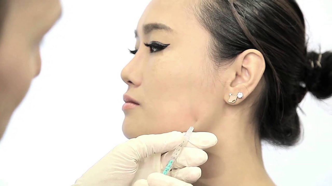 V-Shape Jaw Muscle Reduction with Xeomin or Botox