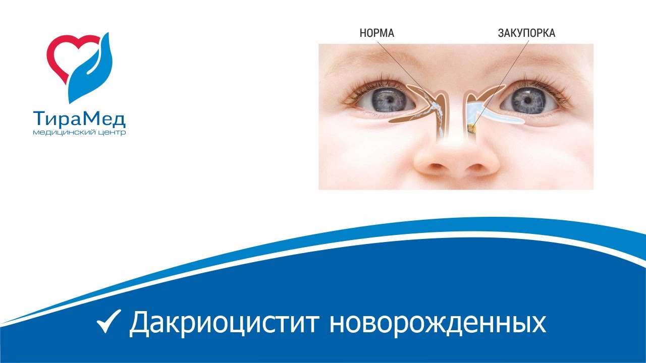 Дакриоцистит новорожденных
