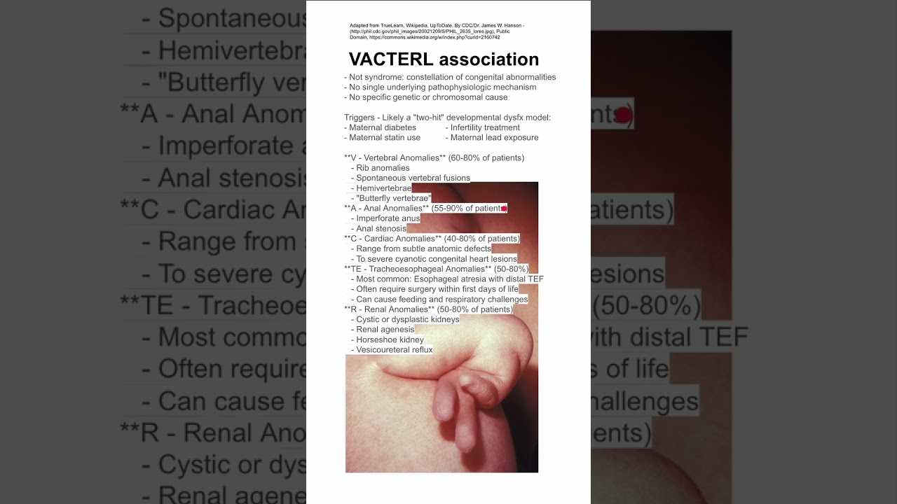 VACTERL association
