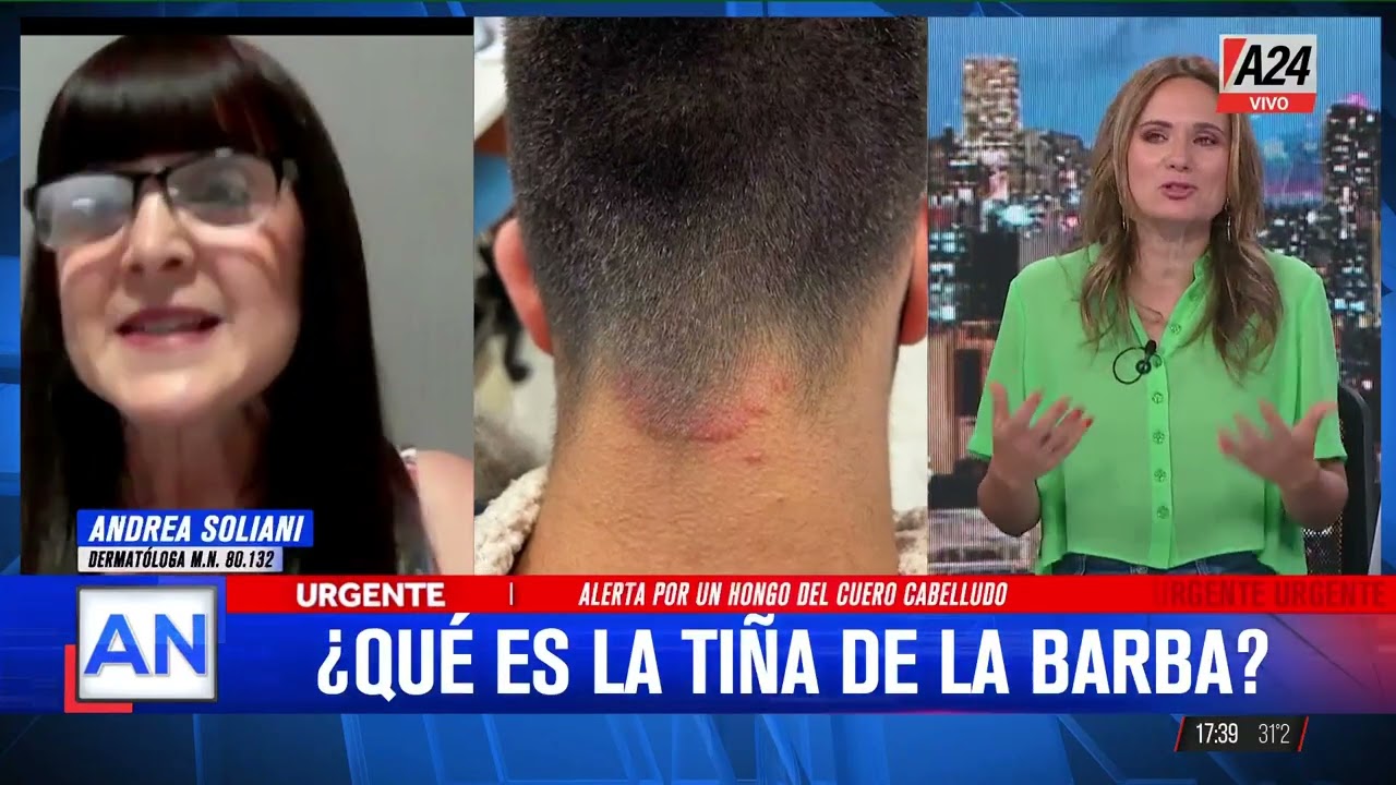 🚨Aumentan los casos de tiña capitis en peluquerías y barberías de Argentina
