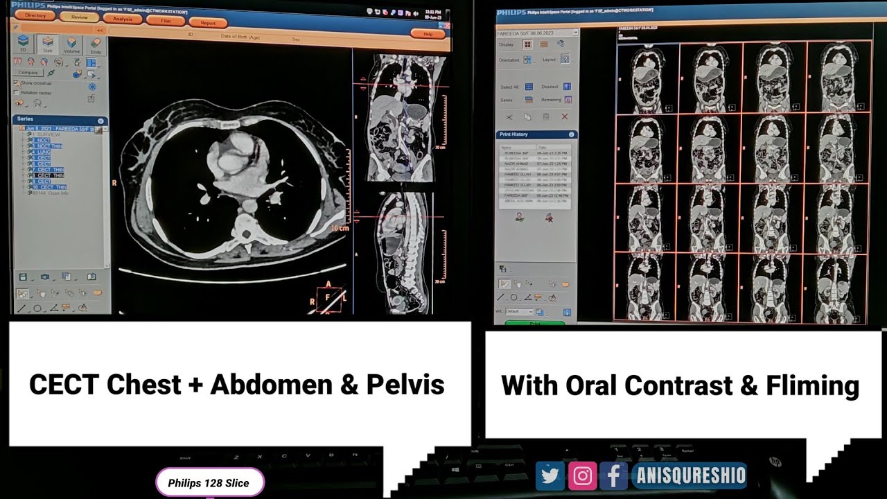 CECT Chest + Abdomen & Pelvis with Oral Contrast and Fliming| By Anis Qureshi