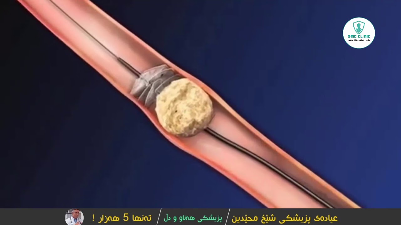 لابردنی بەردی گورچیلە
