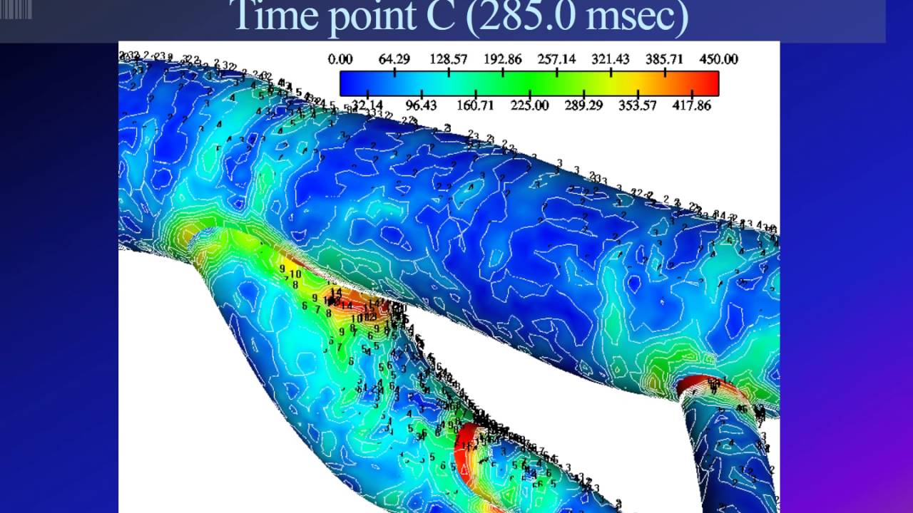 Cardiovascular Engineering. A Computational Fluid Dynamics Approach