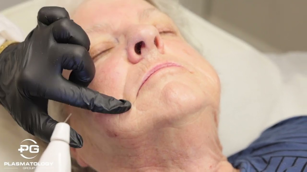 Cat Scratch Resurfacing With Plasma... Scratch years off your skin with Cat Resurfacing!