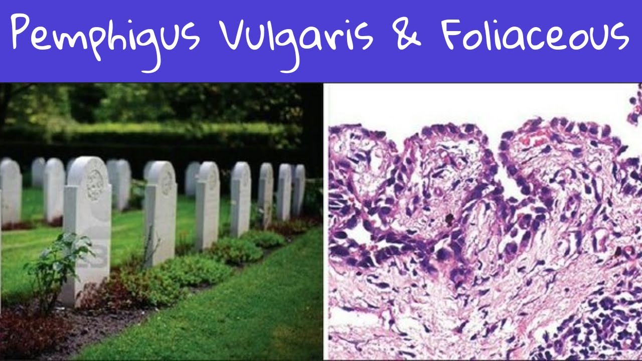 Pemphigus Vulgaris & pemphigus foliaceous #pathology lectures #pathology