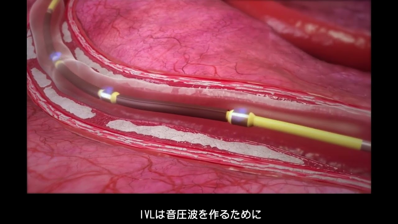 Shockwave IVL Mechanism of Action (MOA) - Japanese Translation & Subtitles