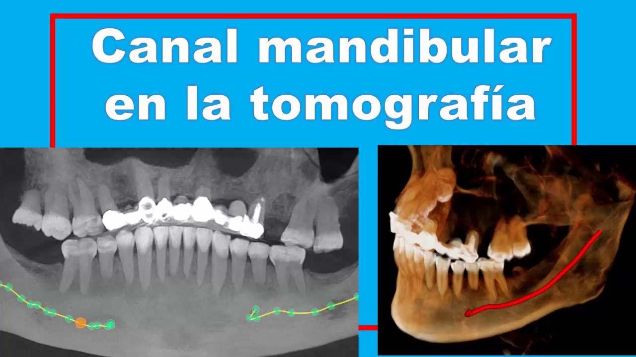 Señalar el canal mandibular en la Tomografía