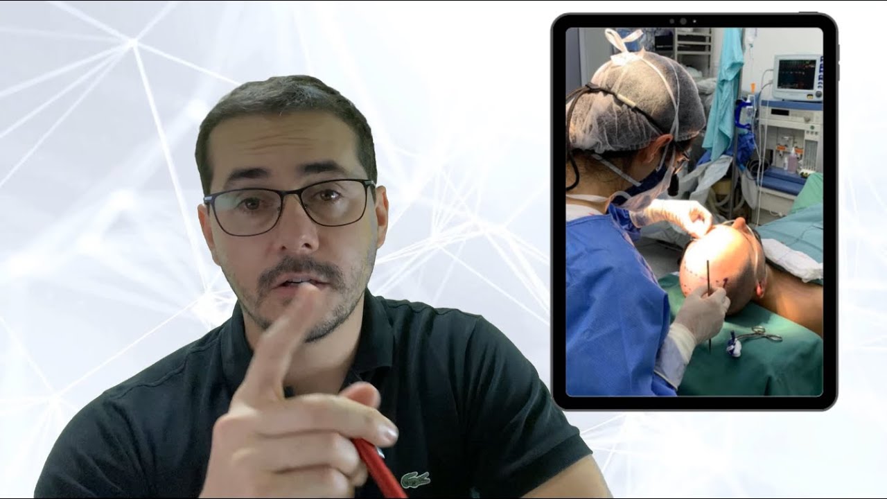 TRANSPLANTE CAPILAR FUE - EVOLUÇÃO MES A MES - 4 Meses | Baixa Autoestima (Vaiiiiii Cabelinhoooo!!)