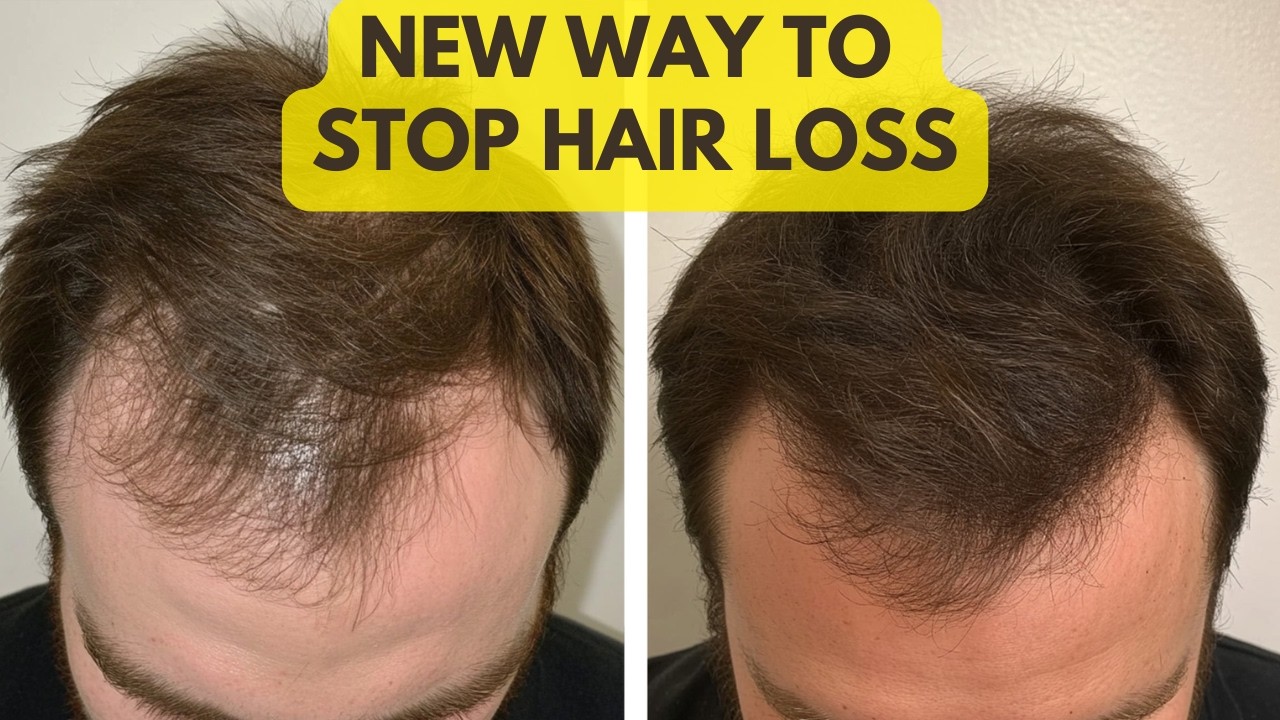 Is Scalp Tension The Real Cause of Male Pattern Baldness?