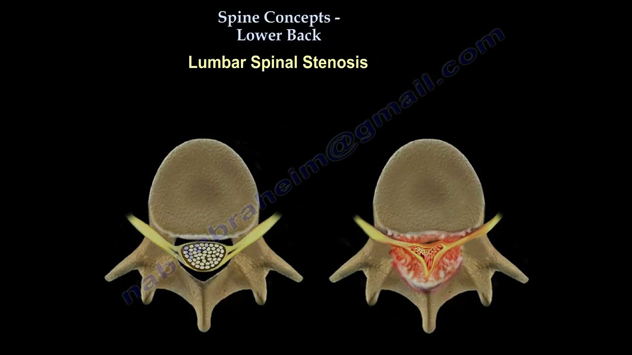 Low Back pain, lumbar stenosis, spinal stenosis