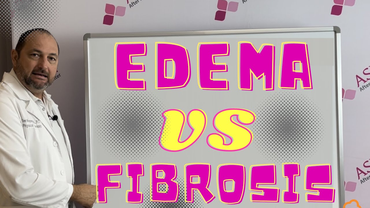 Edema VS Fibrosis- What's the Difference? Liposuction Contour Irregularity / Lipo Lumps and Bumps