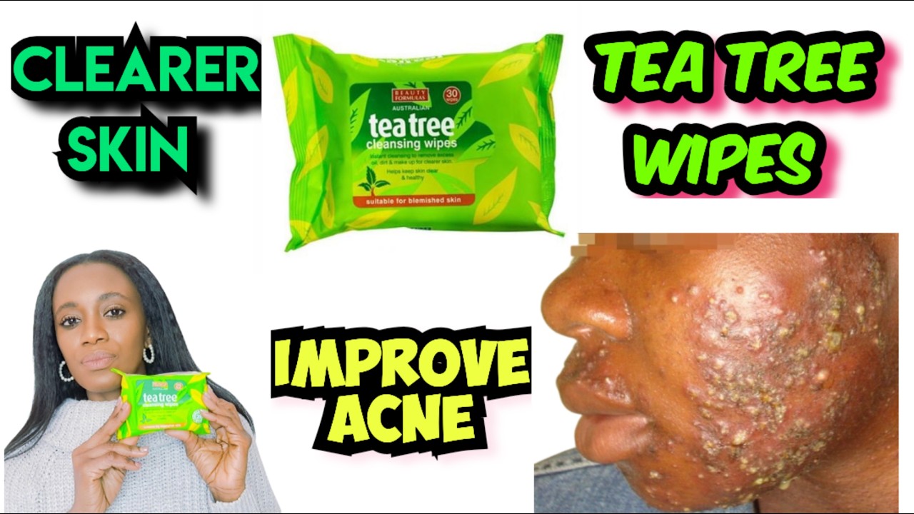 Tea Tree Facial Wipes From Beauty Formulas, Review. Remove Acne And Clear Skin.