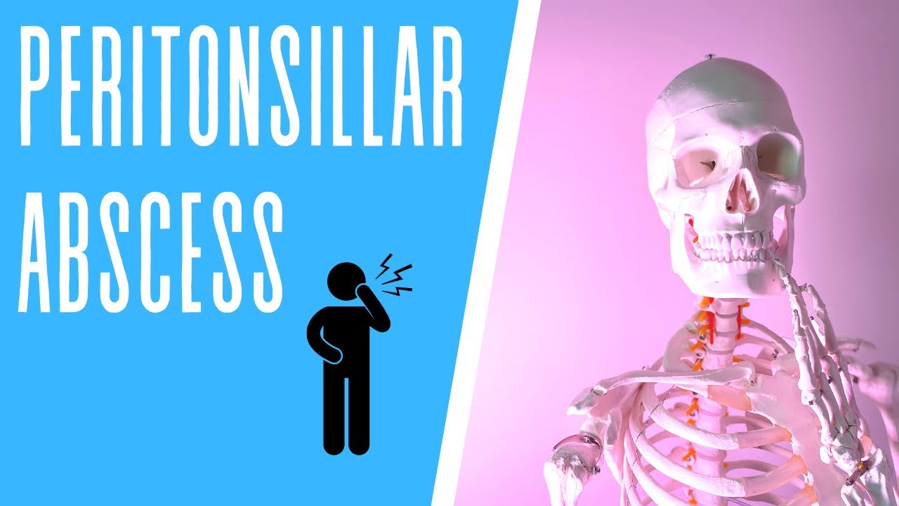 Peritonsillar Abscess: Symptoms, Diagnosis, and Treatment
