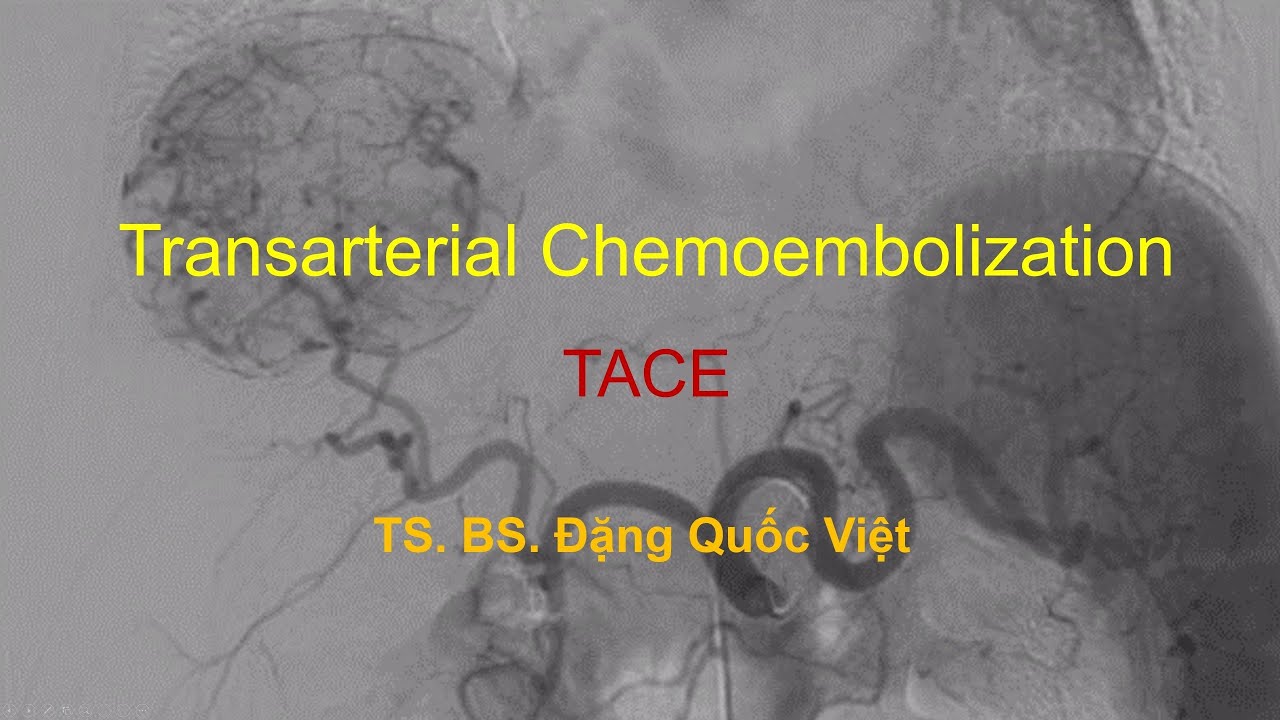 Tắc mạch hóa chất qua ngã động mạch (Transarterial Chemoembolization: TACE)