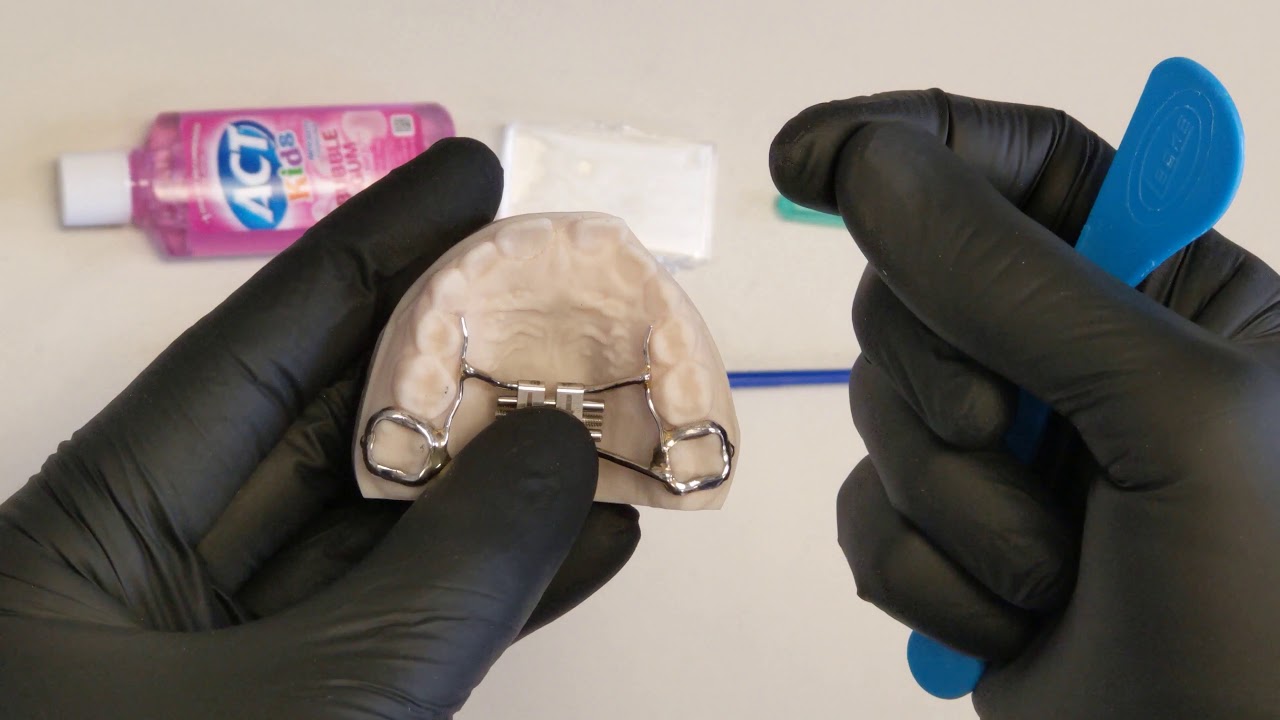 You just got your palate expander, now what?
