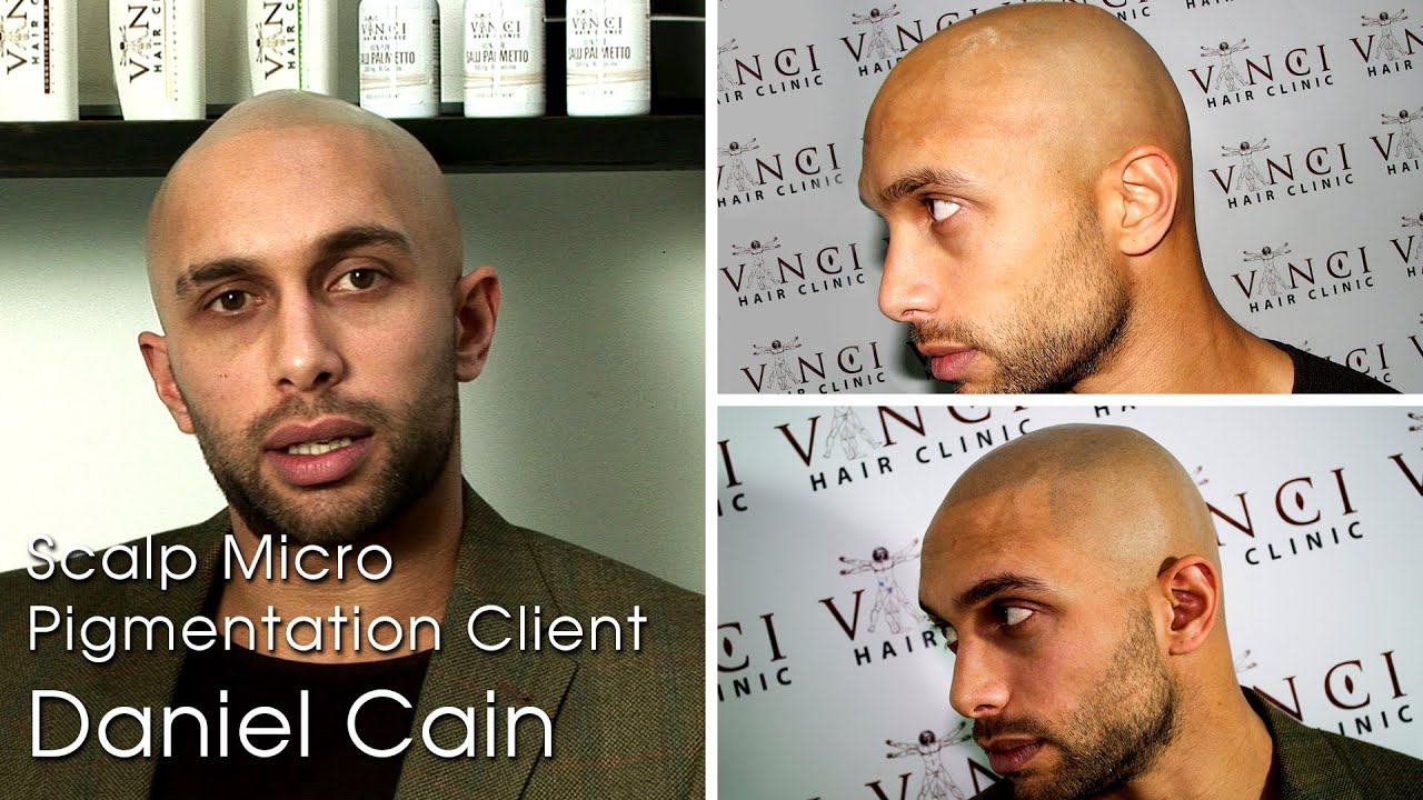 SMP Scalp MicroPigmentation Manchester - Vinci Hair Clinic