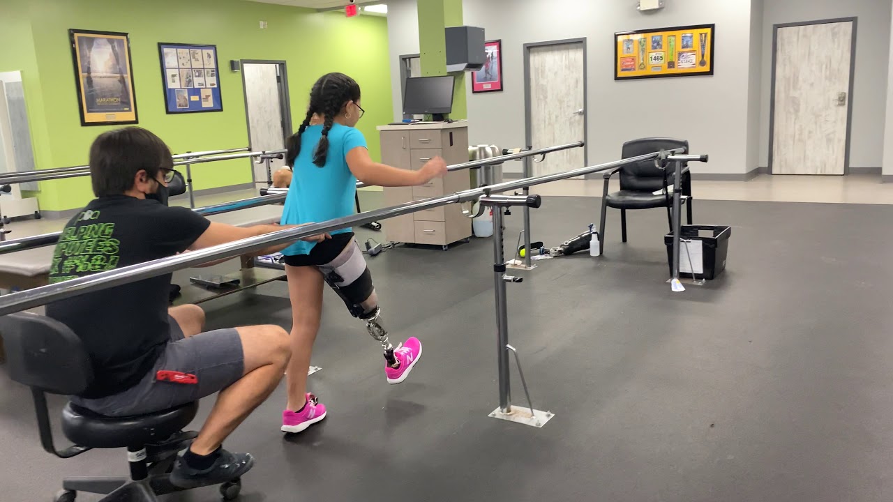 Knee Disarticulate Amputee on PPS Prosthetic Leg Socket System