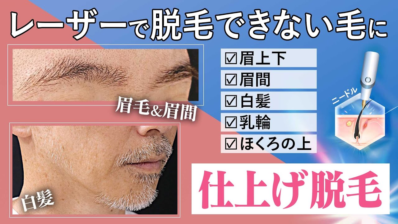 【医療脱毛】ニードル脱毛なら毛根を１本１本ピンポイントで破壊するからどんな毛にも対応！