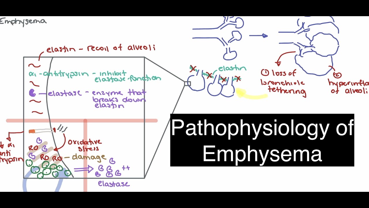 Emphysema Pathophysiology