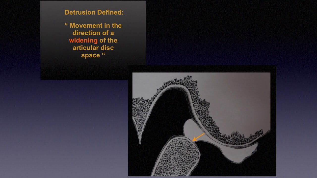 Part 1, TMJ disc Derangements, how & why