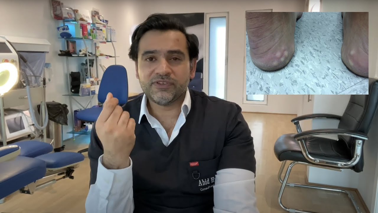 Bumps at the back of the Heel - piezogenic pedal papules